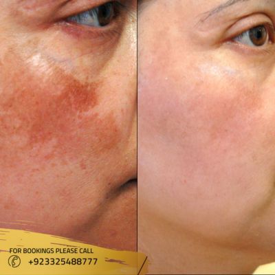 Skin Pigmentation Treatment in Islamabad, Rawalpindi & Pakistan
