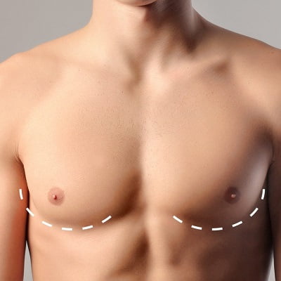 Can I remove gynecomastia myself