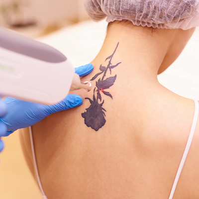 Find the Most Reliable Tattoo Removal Service for Your Skin