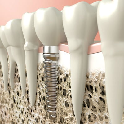 Can a Failed Dental Implant be Removed