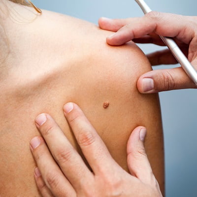 Is Bleeding Normal After Mole Removal Treatment