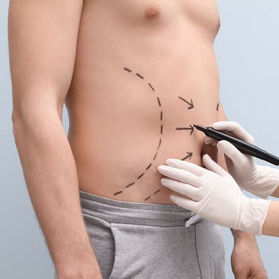 it possible to remove all fat in liposuction