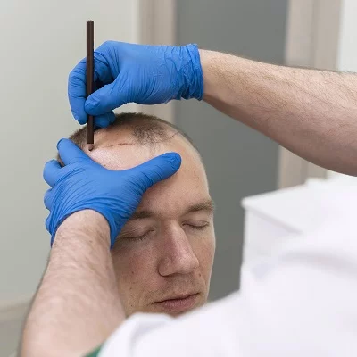 Does Hair Transplant Surgery Leave Scars