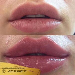 Lip fillers before after results
