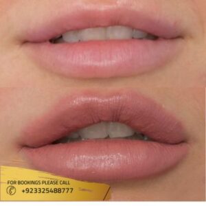Lip fillers in Islamabad results