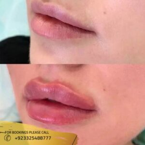 Lip fillers treatment