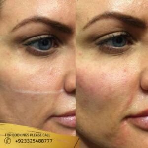 Brow lift surgery before after results