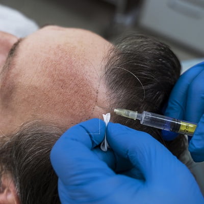 Does Scalp Micropigmentation Works with Grey Hair
