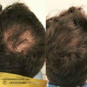 Hair loss treatment before after results
