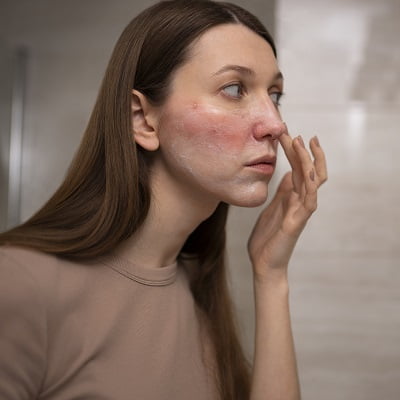 Top Solutions for Common Skin Conditions Acne, Eczema, & Psoriasis