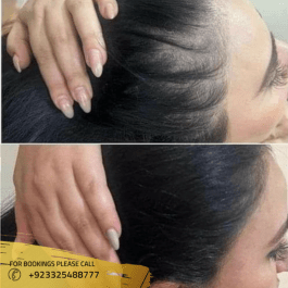 Cost of Exosomes Hair Therapy in Pakistan