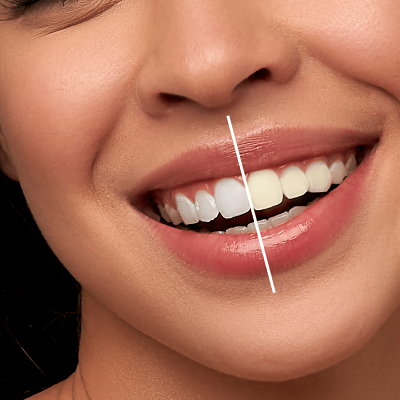Does teeth whitening work on damaged teeth