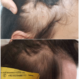 exosomes hair loss results in islamabad