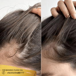 exosomes hair therapy near me