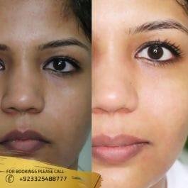 Before and After Skin Whitening Injection