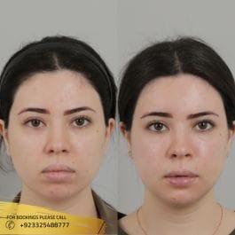 Contouring Surgery - Plastic surgeon in islamabad