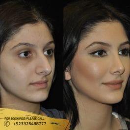 Rhinoplasty Surgery in Islamabad - Plastic Surgery results