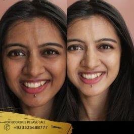 Skin Whitening Injection results