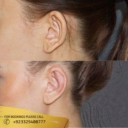 otoplasty surgery in islamabad - Dr Naveed