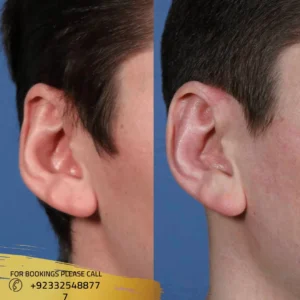 Before after of Ear Surgery