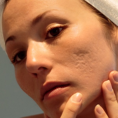 Can Radio Frequency Help in Breaking Up Acne Scars Tissue