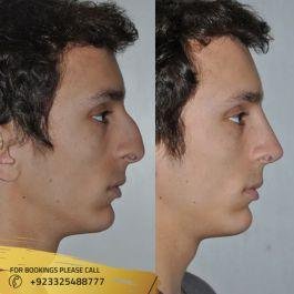 Liquid Rhinoplasty in islamabad results