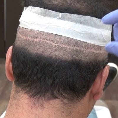 Would scarring after a hair transplant be visible