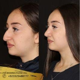 before after results of Liquid Rhinoplasty