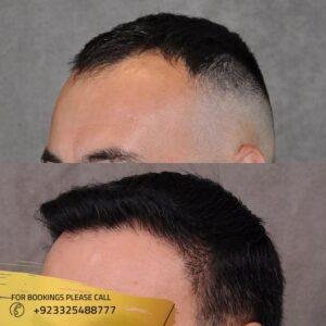 before after results of hair transplant in pakistan