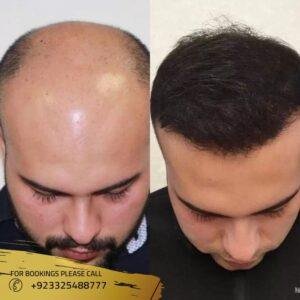 cost of hair transplant in islamabad, pakistan
