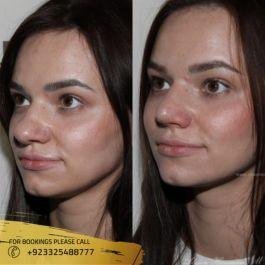 cost of liquid rhinoplasty in islamabad pakistan