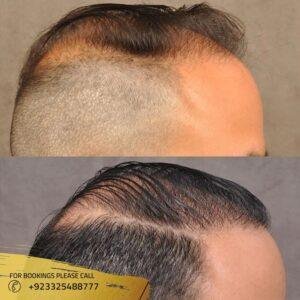 hair transplantation results before after