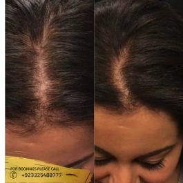 3 month prp for hair loss before and after