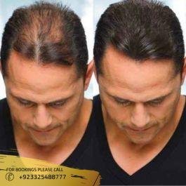 Before After Photos of PRP in Islamabad