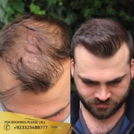 Before & After Results of Hair Transplant