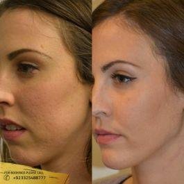 Cosmetic Surgery results in pakistan