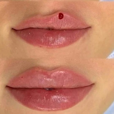 Cost of Lip Border Fillers in Islamabad