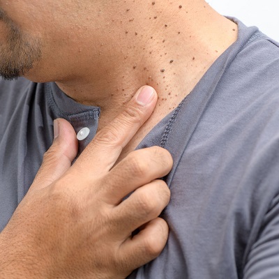 Does skin tags removal treatment leave scars on the skin
