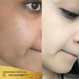 Glutathione skin whitening injections in islamabad reviews