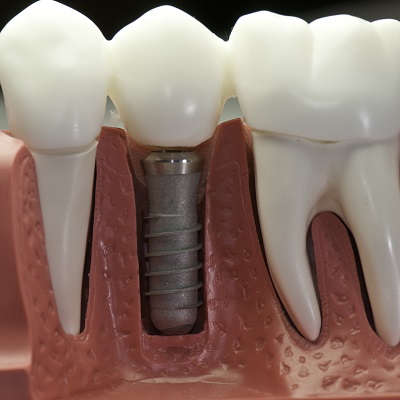 How Many Stitches After a Dental Implant
