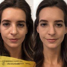 before after photos of dermal fillers