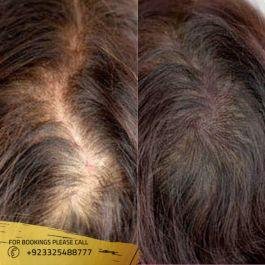 prp hair treatment before after pictures