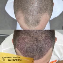 results of Hair Transplant in pakistan