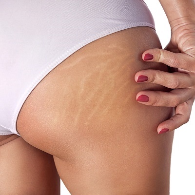 Best Treatments for Stretch Marks Removal