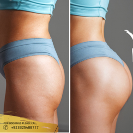 Buttock Fillers before after results
