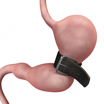 How Much Weight Is Lost Immediately After Bariatric Surgery