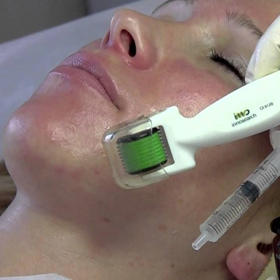 Inno Peel Treatment in Islamabad