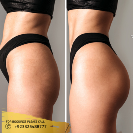 Results of Buttock Fillers in Islamabad