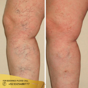 Varicose treatment results in Islamabad