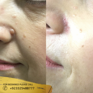 before after of warts removal in islamabad